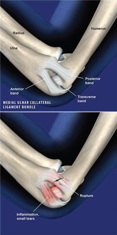 ulnar collateral ligament tear